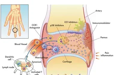 Importance of Accurate Coding in Rheumatoid Arthritis Diagnosis and Management