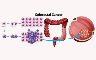 Routine Screening for Colorectal Cancer to Facilitate Early Diagnosis and Treatment