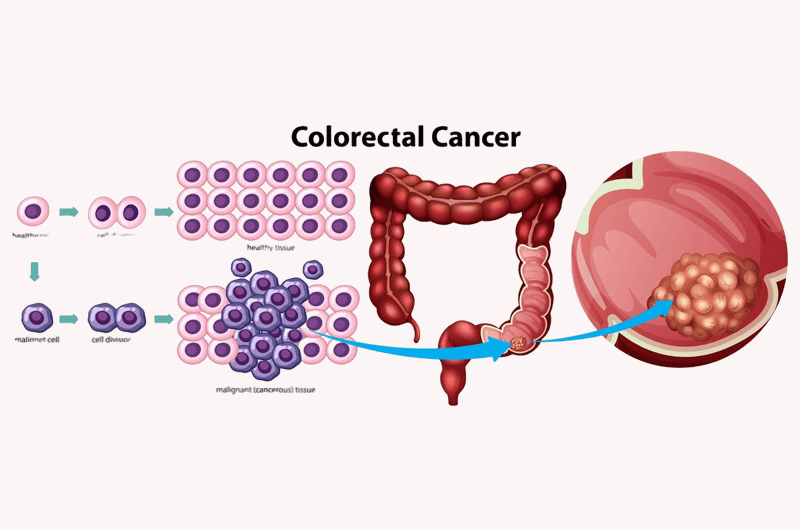 Routine Screening for Colorectal Cancer