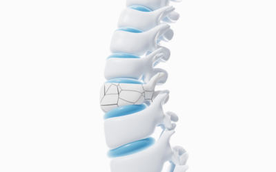 Vertebral Fracture Coding in ICD-10-CM