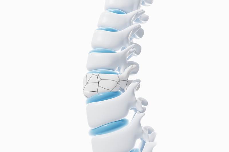 Vertebral Fracture Coding in ICD-10-CM