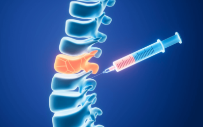 New Epidural Injection Codes to Improve Pain Management Reimbursement in 2017