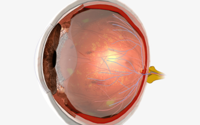 Expanding Role of Telemedicine in Diabetes Retinopathy Screening