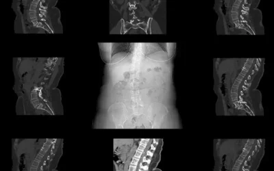 How to Document Spondylolisthesis with Accurate ICD-10 Codes