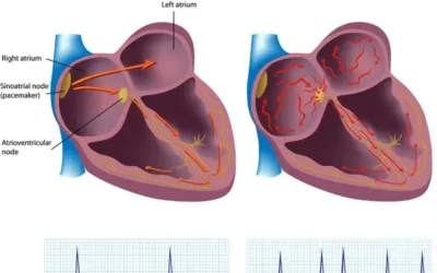 Coding Atrial Fibrillation Using Correct ICD-10 and CPT Codes