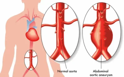 Abdominal Aortic Aneurysm (AAA) – Screening and Coding Guidelines