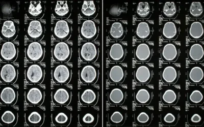 Documenting and Coding Subdural Hematoma – Know the ICD-10 Codes