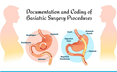 Documentation and Coding of Bariatric Surgery Procedures