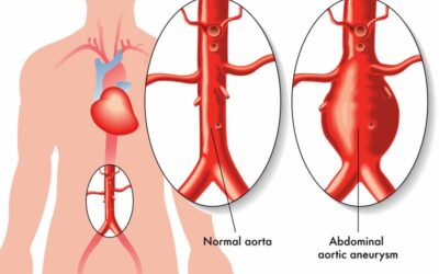 Abdominal Aortic Aneurysm Repair – Report the Correct CPT Codes