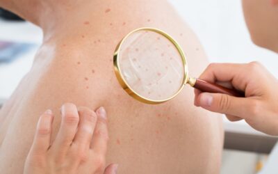 Actinic Keratosis – Coding, Billing and Clinical Information