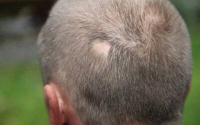 Reporting Alopecia Areata using ICD -10 Codes