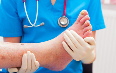 Diagnosing and Documenting Charcot’s Foot – An Overview