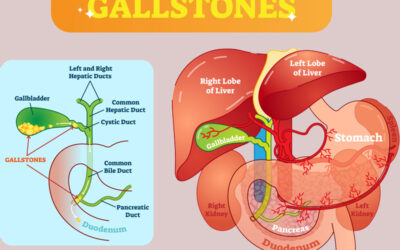 Coding Gall Stones – An Overview of the Symptoms and Treatment