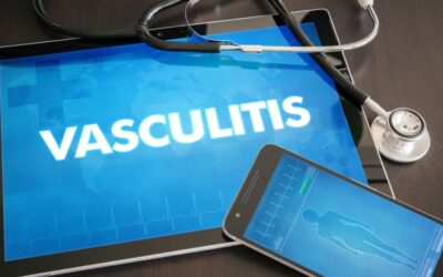 Coding Vasculitis, a Common Autoimmune Disease in ICD-10