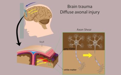 Coding Diffuse Axonal Injury – A Common Traumatic Brain Injury