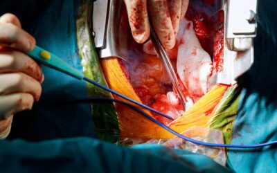 What Is TAVR And How To Code For TAVR Procedure?