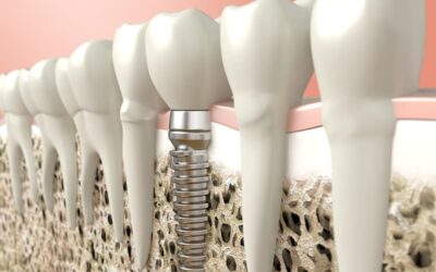 CDT Codes to Report Dental Implant Services