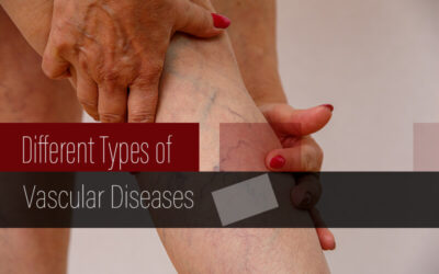 Coding Different Types of Vascular Disease – A Look at the Related ICD-10 Codes