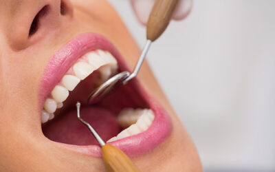 How Do You Report Fractured Tooth Using ICD-10?