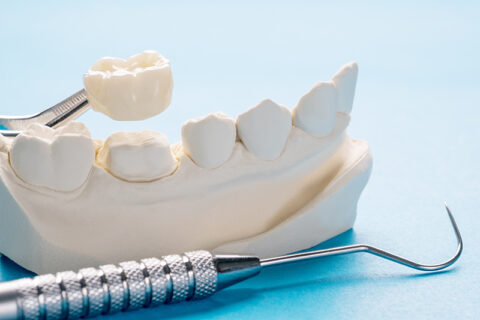 CDT Codes To Document Dental Bridge Procedure   Dental Bridge 480x320 