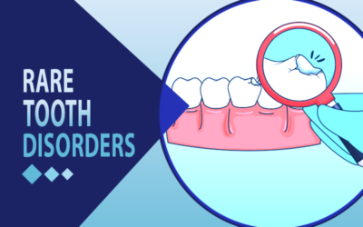 ICD-10 Codes for 11 Rare Tooth Disorders