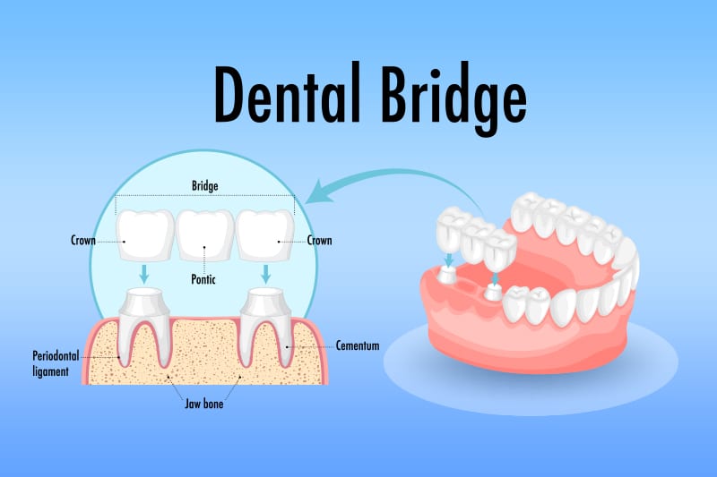 Understanding CDT Codes For Dental Bridges